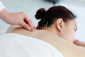hand-doctor-performing-acupuncture-therapy-asian-female-undergoing-acupuncture-treatment-with-line-fine-needles-inserted-into-her-body-skin