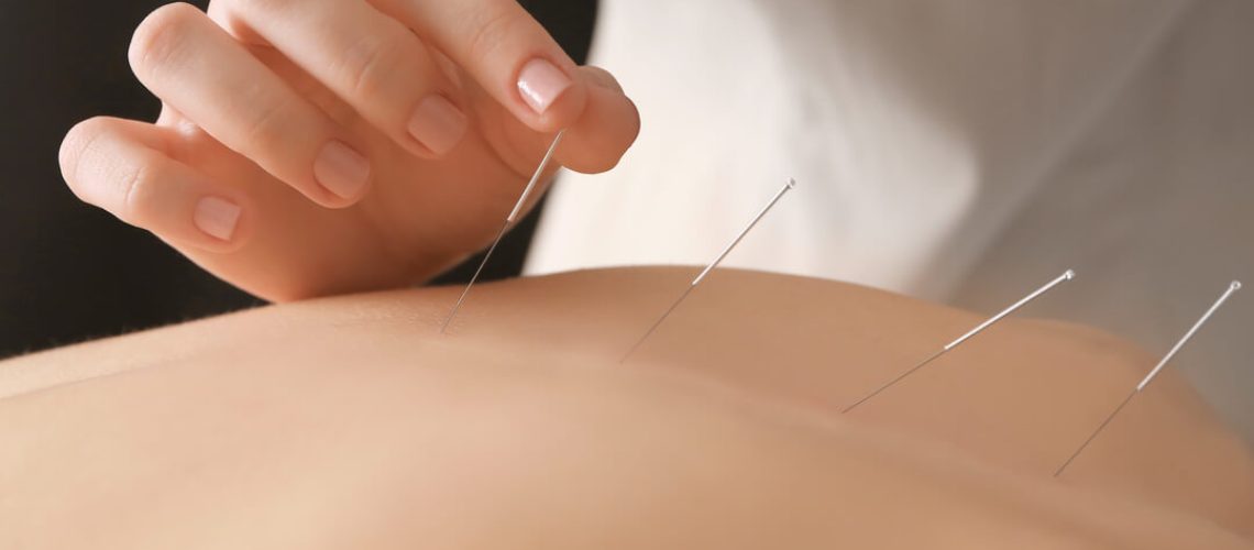 Acupuncture (1)