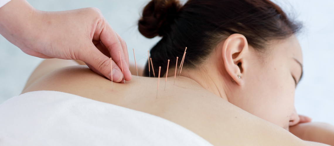 hand-doctor-performing-acupuncture-therapy-asian-female-undergoing-acupuncture-treatment-with-line-fine-needles-inserted-into-her-body-skin